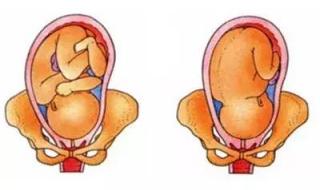 胎位不正怎么纠正 胎位不正怎么纠正