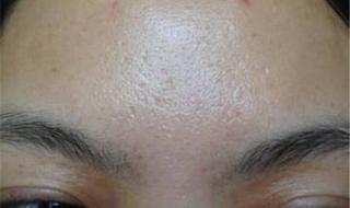 祛痘多少钱 祛痘多少钱